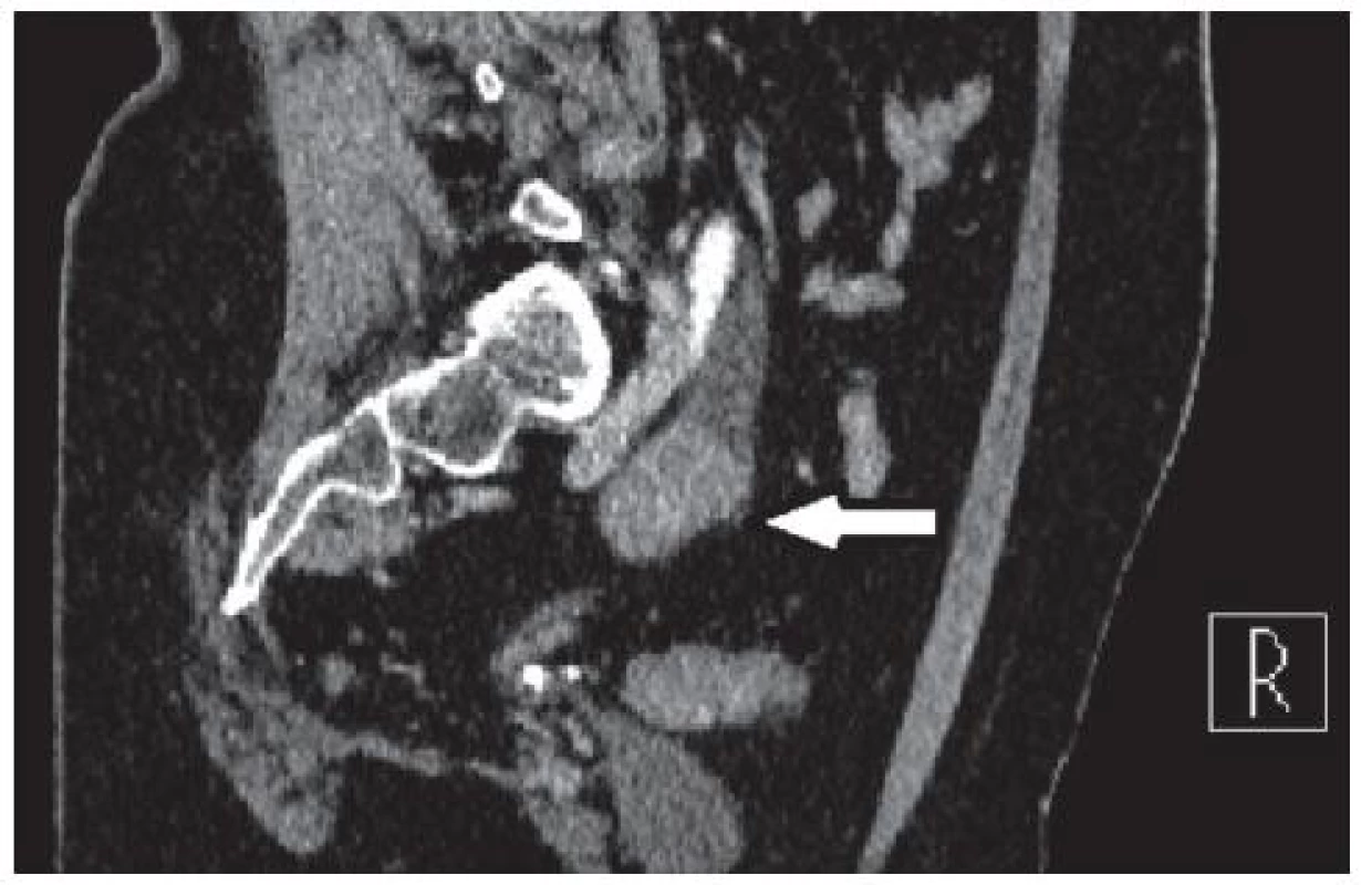 CT po podání kontrastní látky intravenózně – šipka ukazuje na tumor močovodu
Fig. 2. CT after administration of intravenous contrast material – the arrow points to the tumor ureter