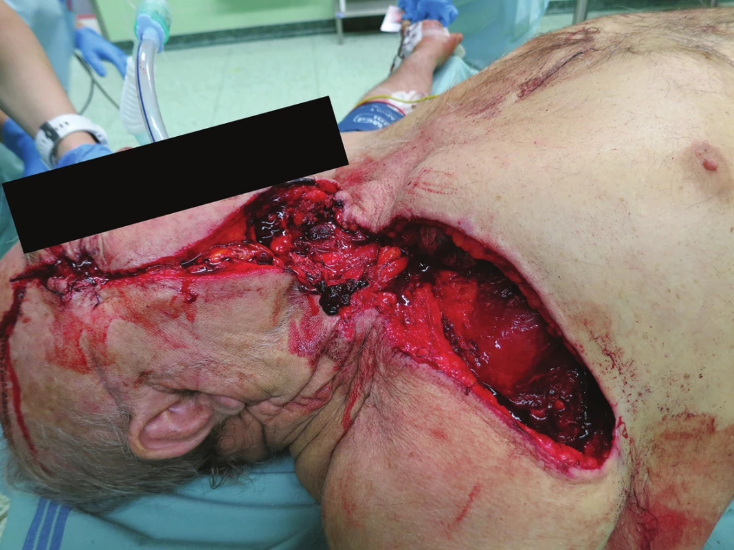 Otevřené poranění hlavy, krku a hrudníku (penetrující) okružní pilou
Fig. 1: Open injury of the head, neck and chest (penetrating) by a circular saw