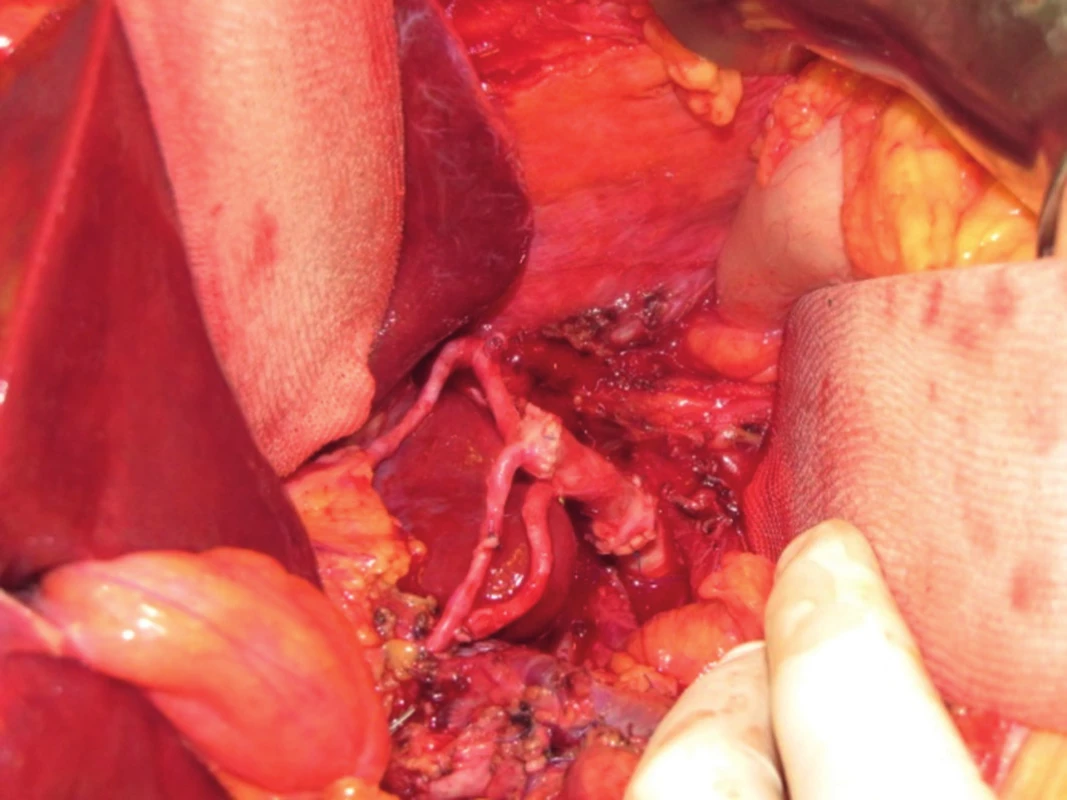 Transplantace jater - anastomóza jaterní tepny štěpu včetně rekonstrukcí jejích větví.