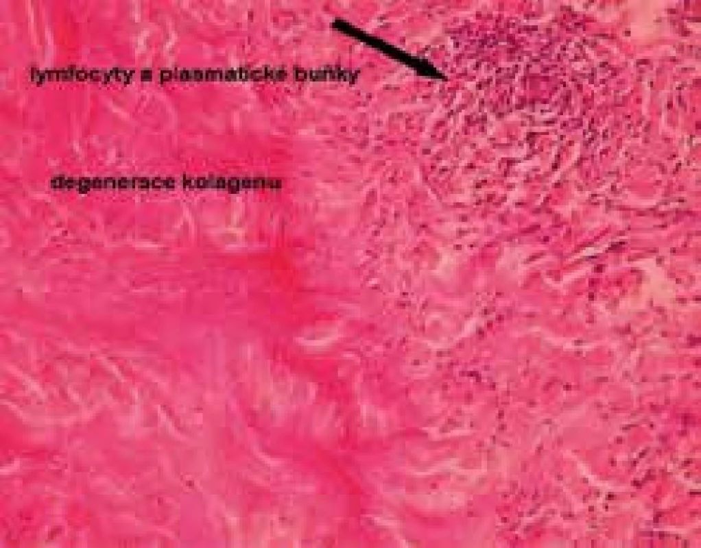Histologie necrobiosis lipoidica, infiltrát z histiocytů a plazmatických buněk, degenerace kolagenu (barvení hematoxylinem a eozinem)