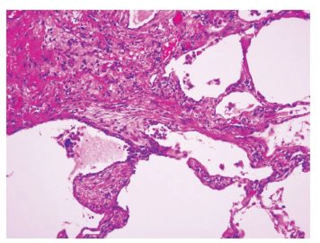 Tzv. fibroblastické ložisko na rozhraní denzní fibrotizace a relativně přiměřeného plicního parenchymu nepostiženého jizvením
