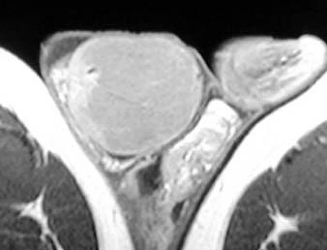 Seminom varlete: pravé varle zvětšené uzlovitou nádorovou hmotou, hypointenzní v T1 MR-obraze.