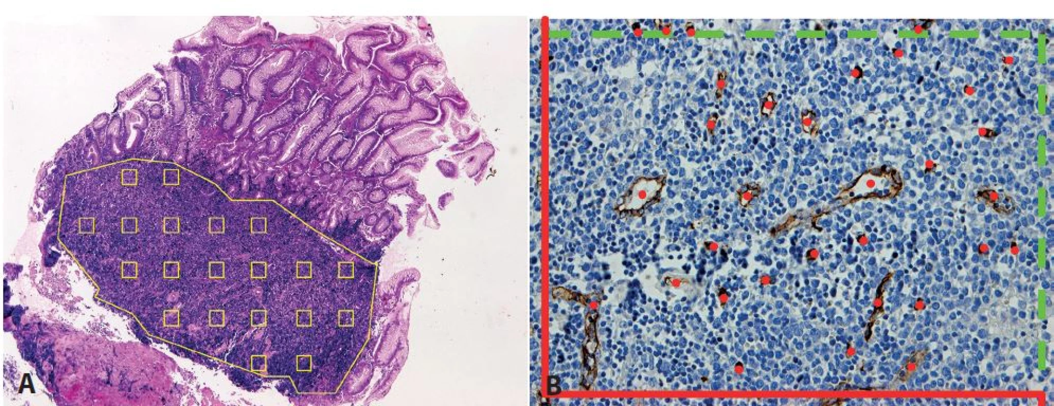 Stanovení mikrovaskulární denzity pomocí metody systematického náhodného výběru zorných polí v definované oblasti. &lt;b&gt;A&lt;/b&gt;: vzorkování v mantle cell lymfomu (MCL) infiltrujícím sliznici tlustého střeva (hematoxylin-eosin, zvětšení 50x). &lt;b&gt;B&lt;/b&gt;: označení počítaných profilů mikrocév v jednom zorném poli MCL v lymfatické uzlině s využitím počítacího rámečku pro tzv. nevychýlené počítání (42), který sestává ze zakázaných linií (červeně, protínající cévní profily nejsou započítány) a povolených linií (zeleně přerušovaně, dotýkající se cévní profily jsou započítány) (protilátka CD34, zvětšení 200x).