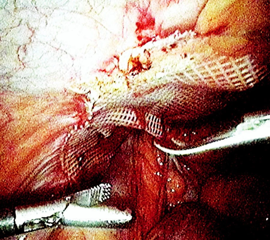 Laparoskopická operace tříselné kýly s použitím síťky
Fig. 1. Laparoscopic inquinal hernia surgery using the mesh
