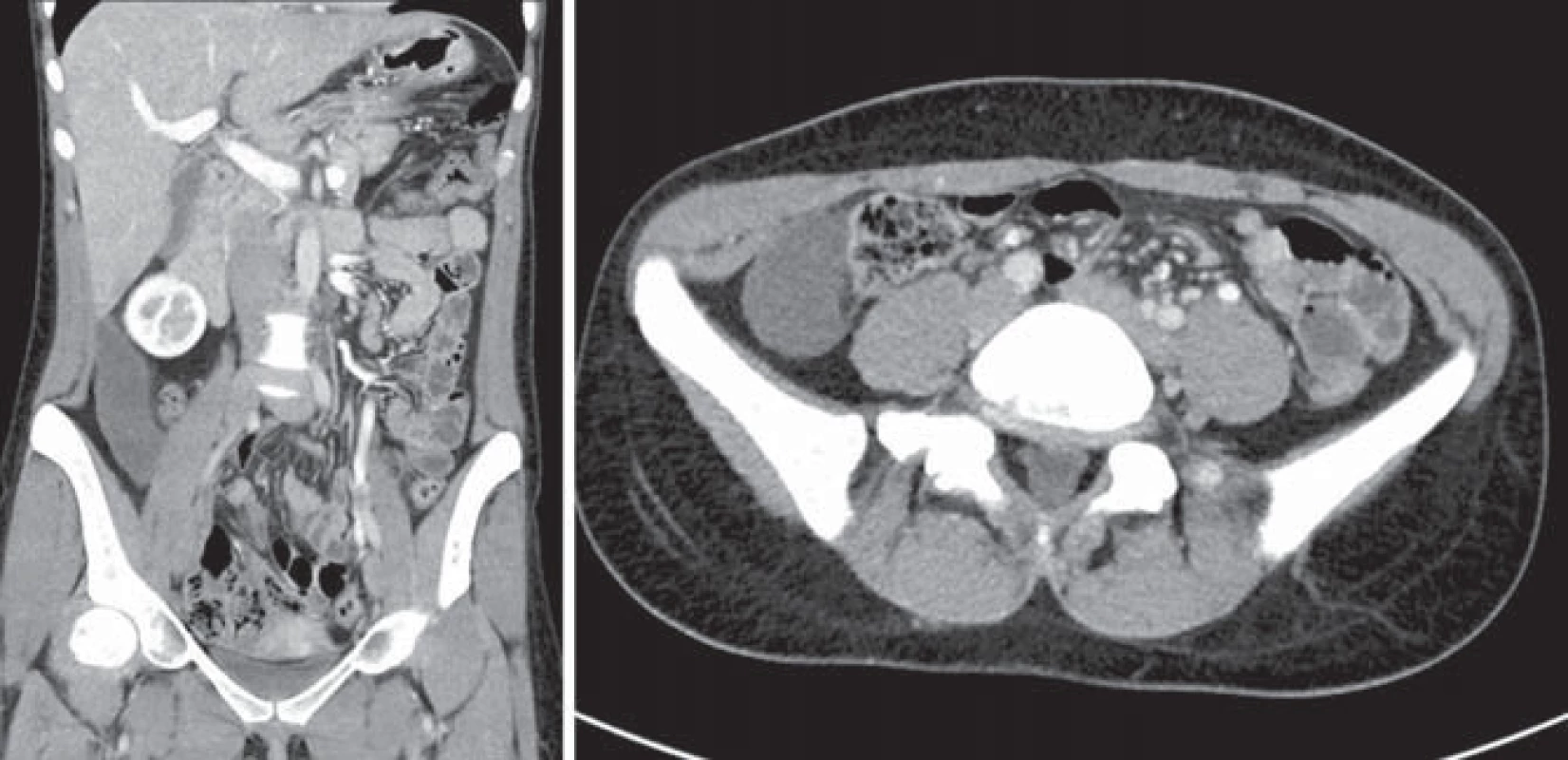 CT vyšetření koronární a transverzální projekce – laterálně od vzestupného tračníku v peritoneální dutině vpravo v mezo- a hypogastriu protáhlý hypodenzní útvar 100 × 32 × 43 mm.