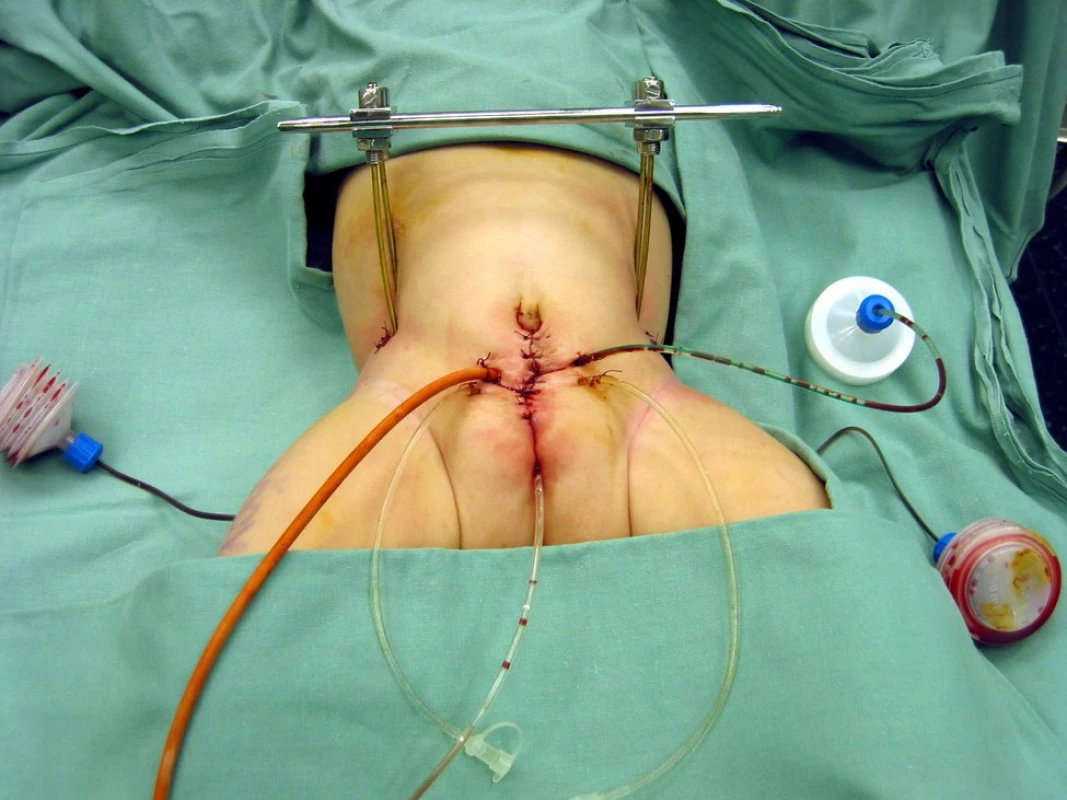 Zevní fixace pánve po operaci extrofie močového měchýře (Archiv FN Brno)