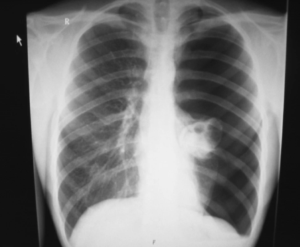 Totální kolaps levé plíce, první recidiva SPNO
Fig. 2. Total pneumotorax, left-sided, first recurrence of SPNO