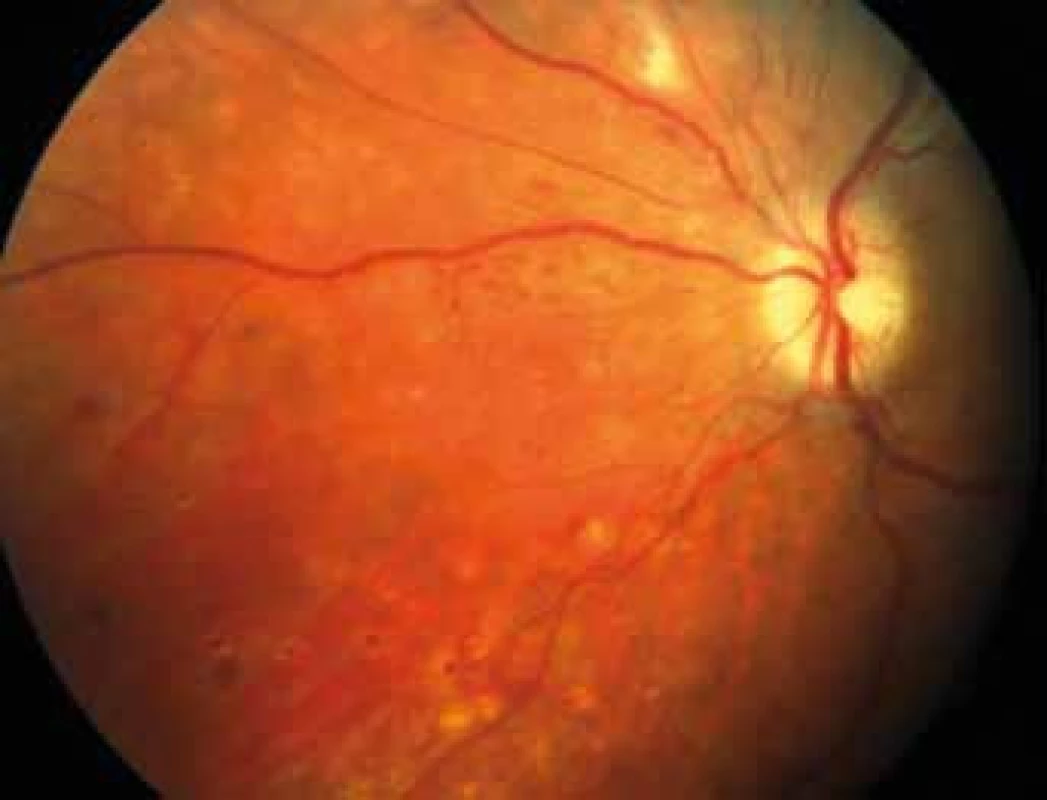 Neovaskularizace terče zrakového nervu a sítnice levého oka.