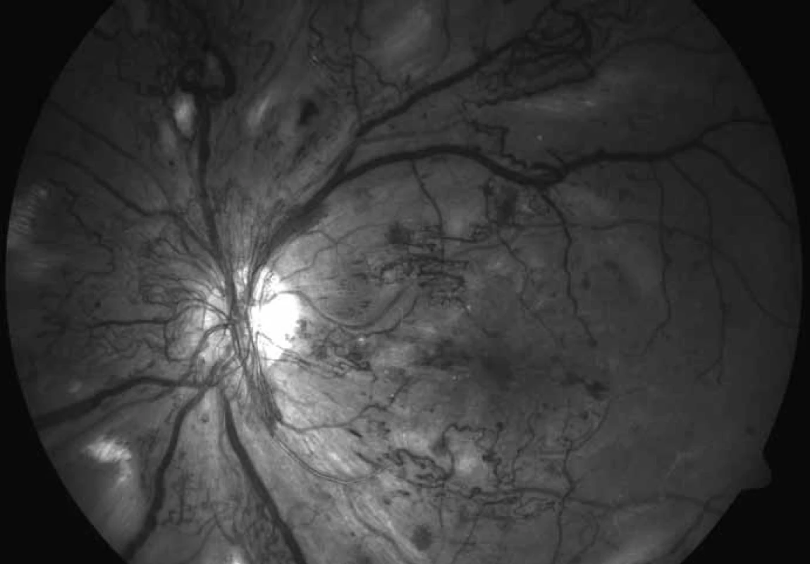 Černobílý obrázek proliferativní formy DR u 35leté diabetičky levého oka zobrazující aktivní neovaskularizace na papile zrakového nervu, šířící se do okolí, četné intraretinální mikrovaskulární abnormality v horní polovině a v zadním pólu, pokročilá flebopatie a kyprá vatovitá ložiska při kmenových sítnicových cévách. Dosud nebyla provedena laserová koagulace sítnice.