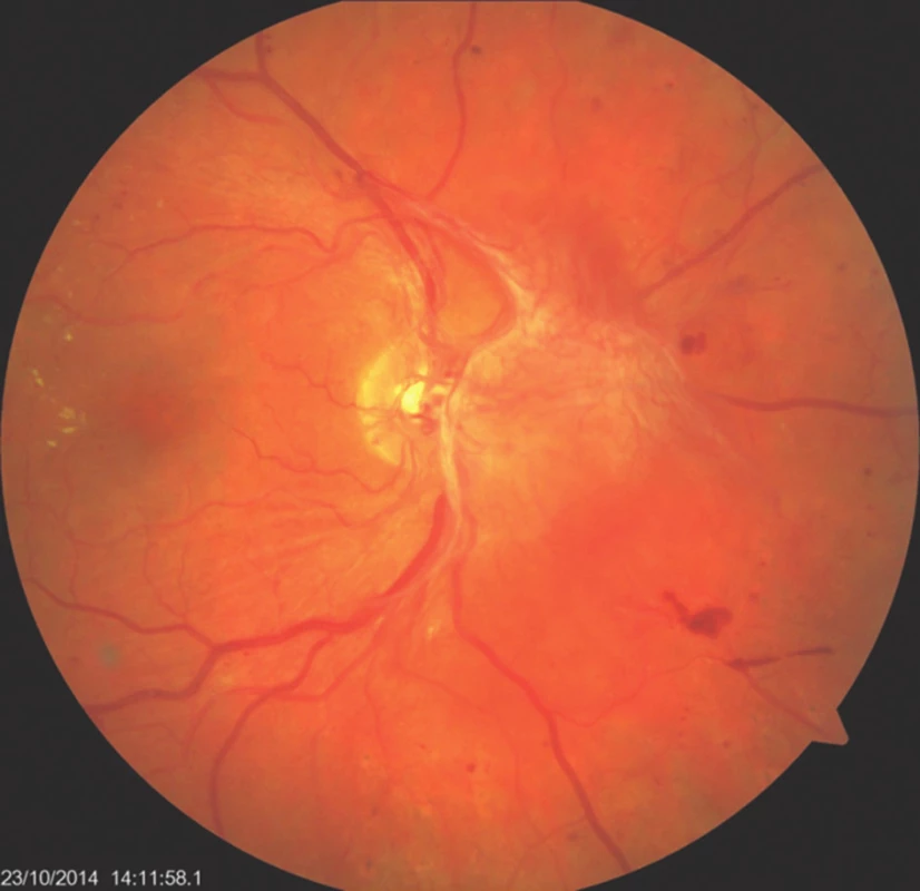 Nález sítnice v oblasti zadního pólu před operačním zákrokem: vějíř papilo-vitreálních a retino-vitreální proliferací, omezeně plněné retinální řečiště, počínající tvrdé exsudace v makule