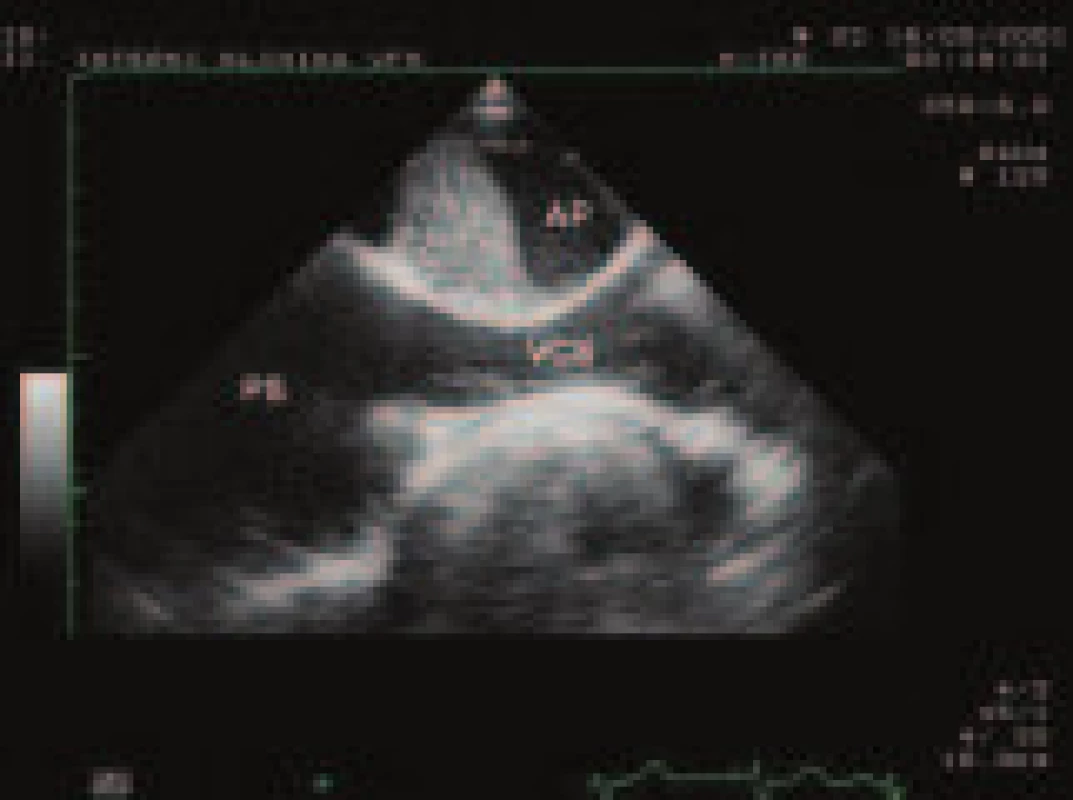 Organizovaný nástěnný trombus v pravé větvi plicnice, zobrazený pomocí jícnové echokardiografie 