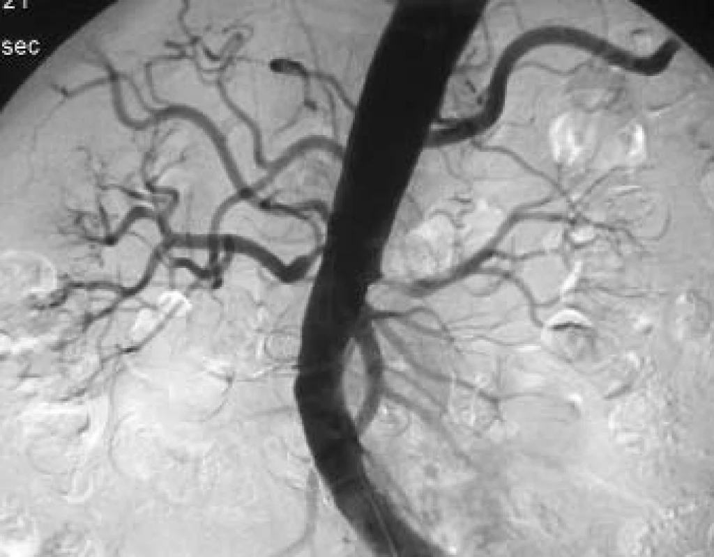 Angiografie AA s hemodynamicky významnými ostiálními stenózami obou renálních tepen.