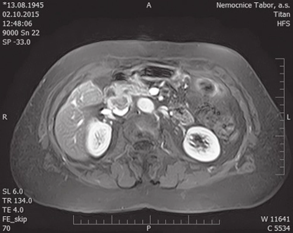 Horizontální řez magnetické rezonance v místě tumoru s patrnou invazí do vena cava inferior
Fig. 3: MRI horizontal cross section with the secondary tumor invading inferior caval vein visible