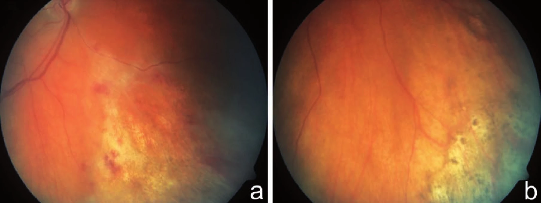 Indolentní forma CMV retinitidy. Fotografie fundu zachycuje periferní léze granulárního vzhledu s ojedinělými hemoragiemi u 59letého pacienta s lymfomem po transplantaci kostní dřeně, s fulminantní CMV retinitidou a poruchou vizu OL, bez poruchy vizu na OP a, b)