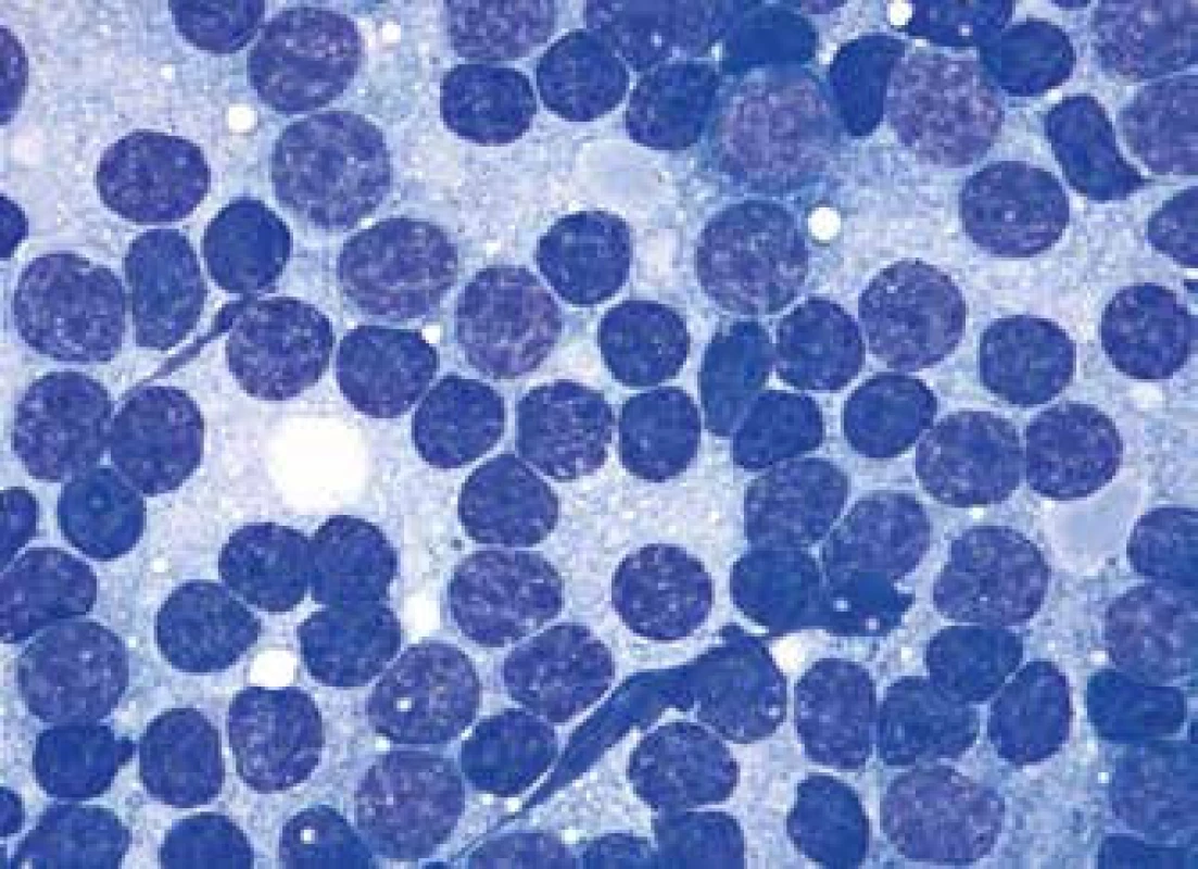 MCL, malobuněčná varianta (infiltrace lymfatické uzliny malými zralými lymfocyty s malým množstvím cytoplazmy a kondenzovaným jaderným chromatinem bez nukleolů, nález je podobný CLL/SLL)
