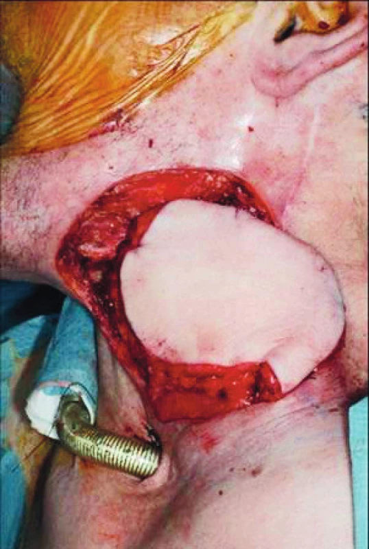 Štěp z musculus pectoralis major použitý k úpravě rozměrného defektu po rozsáhlé záchovné operaci v levé části krku, tracheotomická kanyla