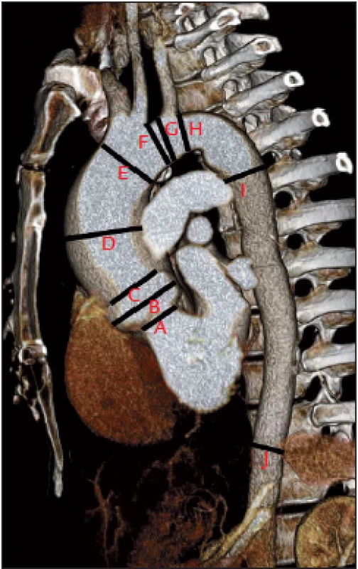 Trojrozměrná rekonstrukce CT angiografi e aorty u nemocného s bikuspidální aortální chlopní. Kromě měření diametrů v oblasti ascendentní aorty (obr. 4) je změřen diametr aortálního oblouku před a za odstupem brachiocefalického trunku (linie E, F), před a za odstupem levé poklíčkové artérie (G, H), diametr začátku descendentní aorty (I) a descen dentní aorty v oblasti bránice (J).