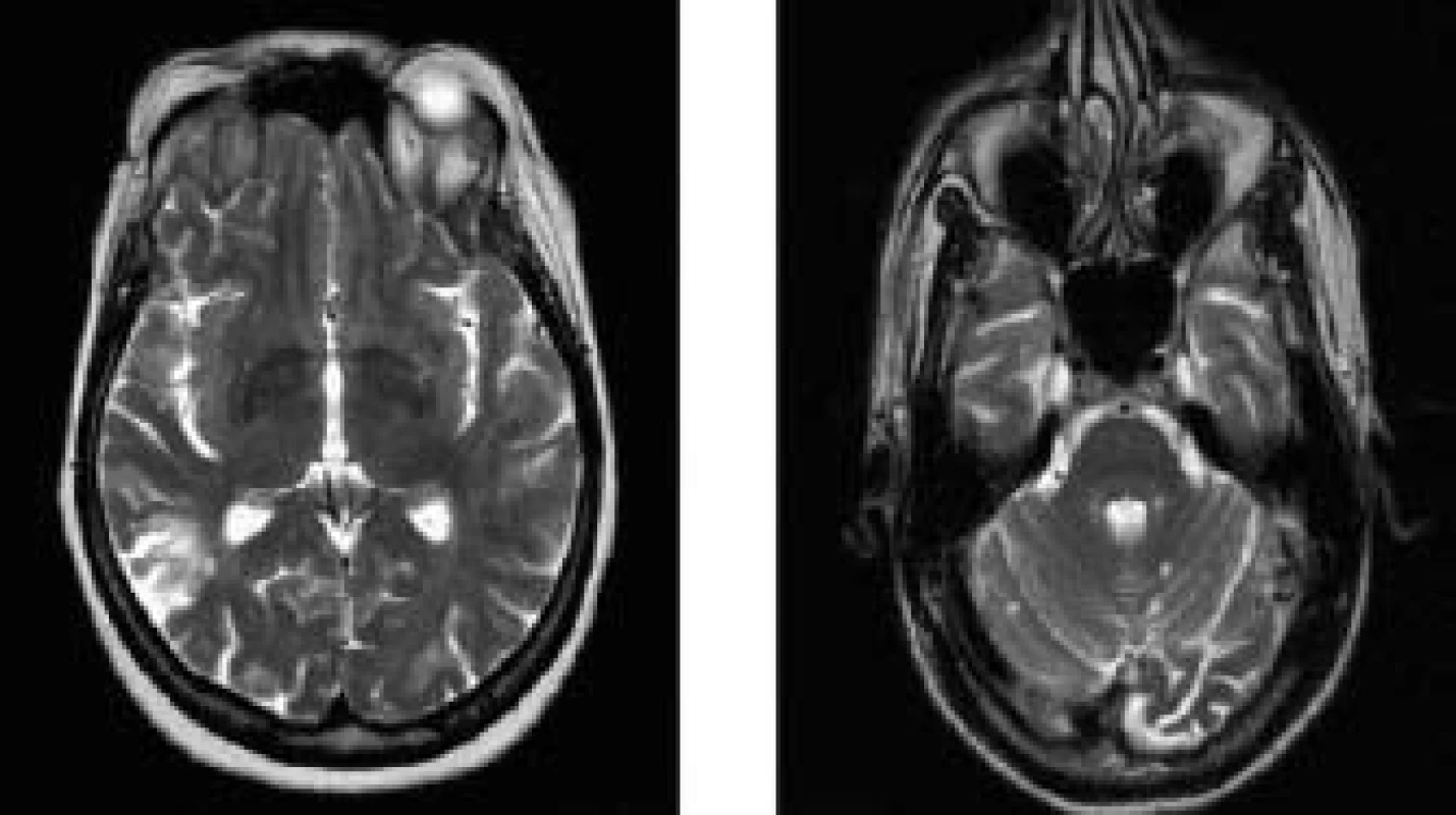 MR l,STv T2 váženém obraze: transverzální řezy mozkem 71leté nemocné s nediferencovaným onemocněním pojiva se sekundárním antifosfolipidovým syndromem: A) hyperintenzní ložiska v bílé hmotě periventrikulárně a subkortikálně, bez atrofie mozku. Klínovité ložisko okcipitálně vpravo. B) infratentoriálně přítomnost hyperintenzních lézí v mozečku.