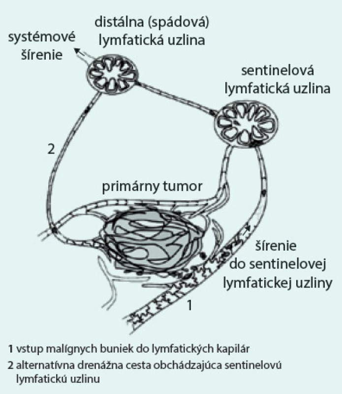 Šírenie buniek malígneho melanómu do lymfatických ciev. Upravené podľa [1].