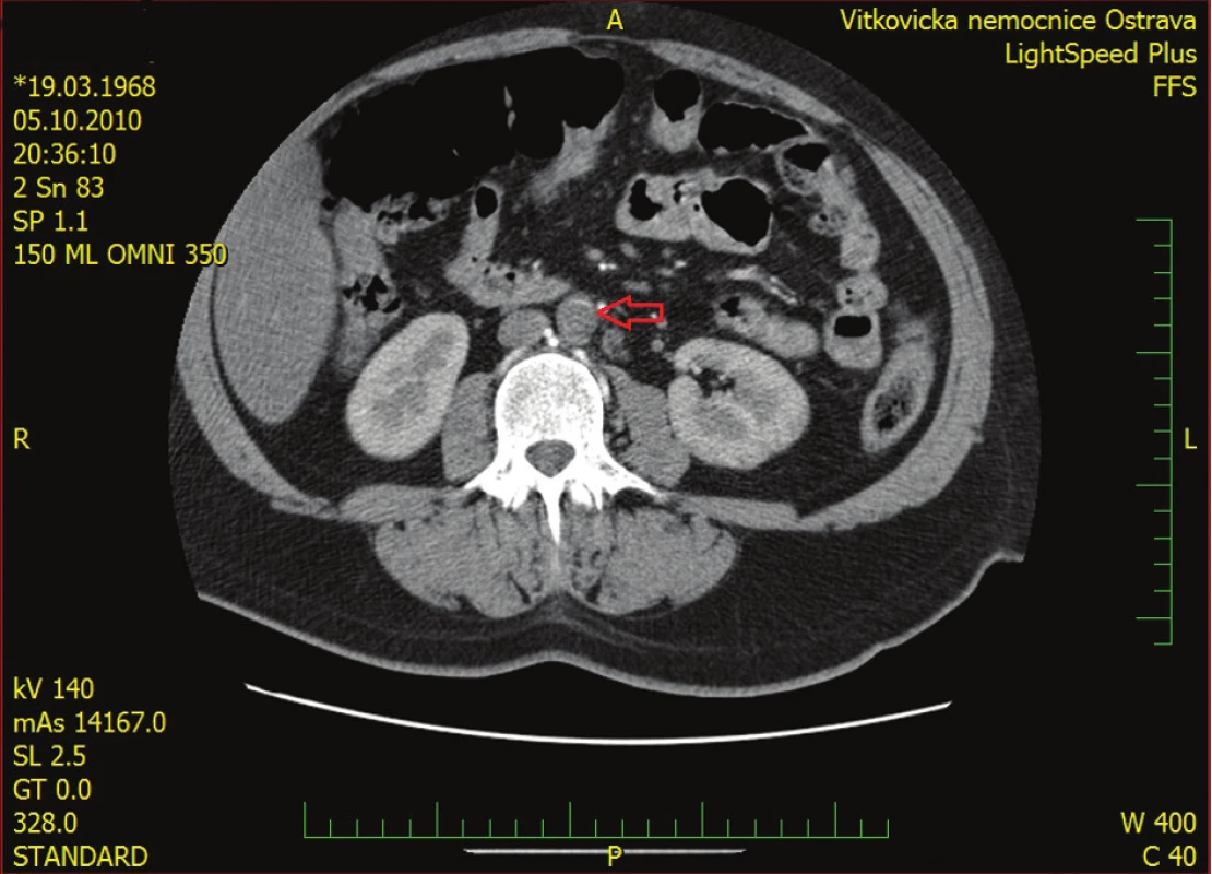 Trombus v břišní aortě
Fig. 1: Thrombus in the abdominal aorta