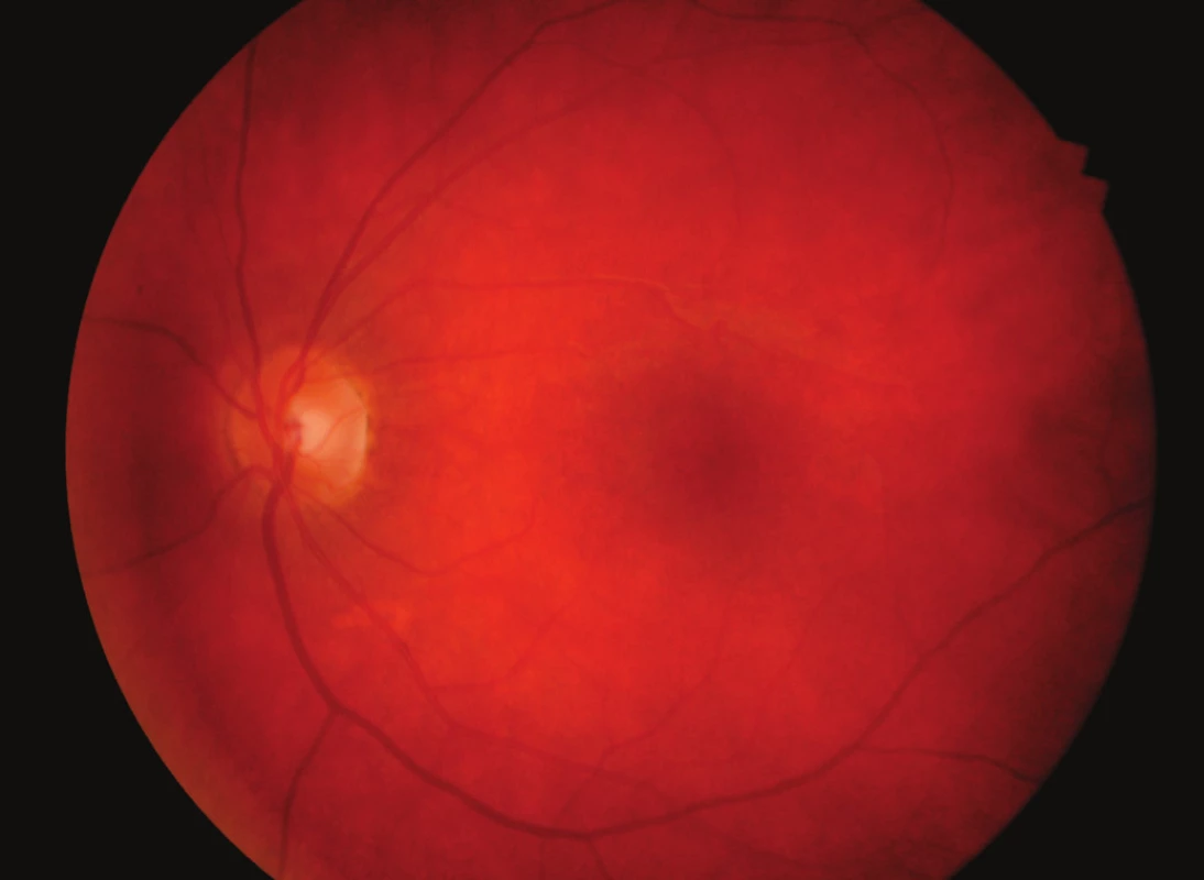 Normální nález v makule levého oka 2 měsíce po léčbě