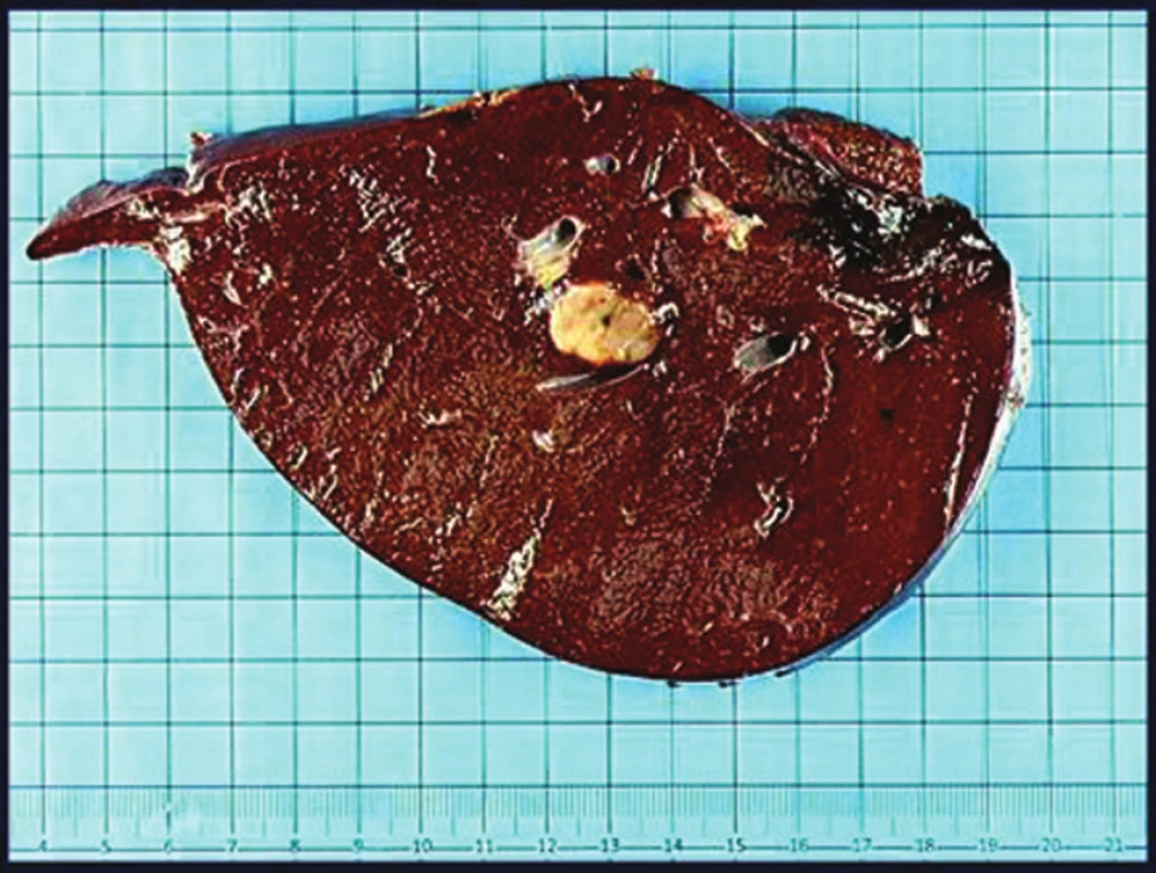 Pacient 1. Pravostranná hepatálna lobektómia s nepigmentovaným metastatickým nodulom veľkosti 20 x 15 mm