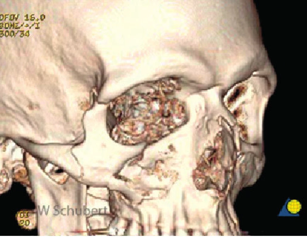 3D rekonstrukce zlomeniny lícně-čelistního komplexu