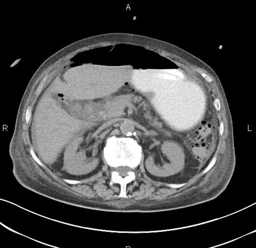 CT vyšetření: pneumoperitoneum pod ventrální břišní stěnou a drobné bublinky plynu v dutině břišní při peritonitidě