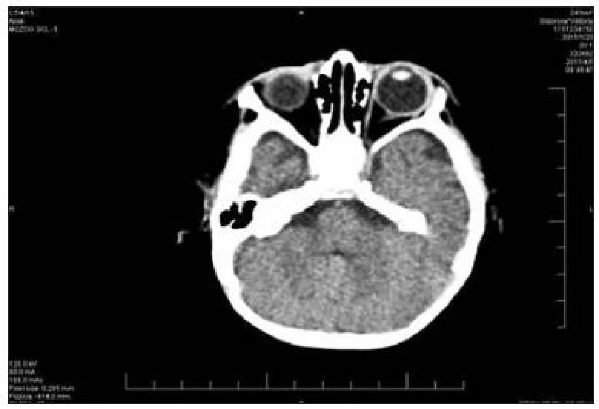 Aplázia zrakového nervu vpravo, CT obraz s KL