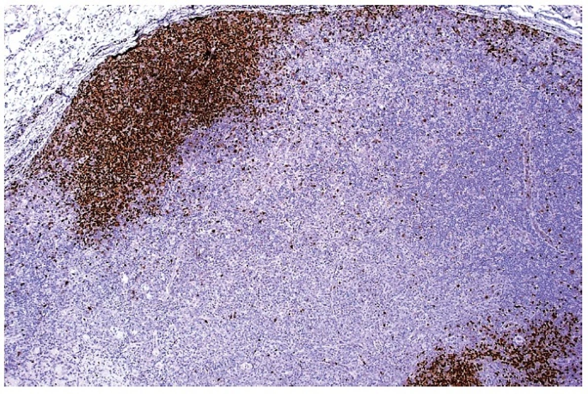 Imunohistochemický průkaz exprese molekuly PAX5 ukazující na zbytkové populace B lymfocytární zóny v uzlině infiltrované aktivovanými buňkami při HNL/K-F. Dobarveno hematoxylinem (zvetšení 20x).