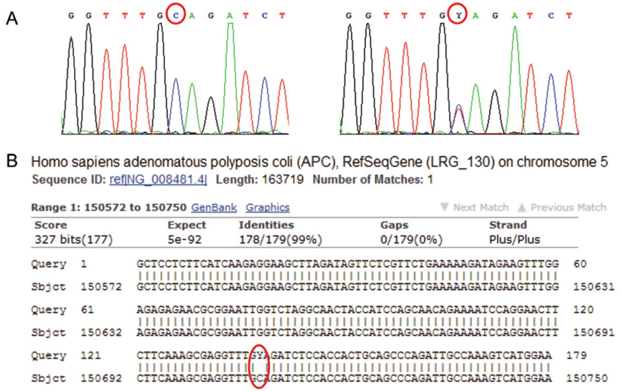 Sekvenogram genu APC (vlevo referenční „wild type“ sekvence, vpravo analyzovaná sekvence). Jedná se o záměnu báze C za T (označení Y pro takovéto báze na jedné pozici), mutace je v heterozygotním stavu; je spojena s onemocněním familiární adenomatózní polypóza střev (FAP). B: Výstup z databáze BLAST – Porovnání analyzované sekvence genu APC (horní řádky „Query“) s referenční sekvencí (spodní řádky „Sbjct“). Označeno je místo bez homologie. V případě homozygotní či hemizygotní mutace by označená báze C byla v sekvenogramu zcela nahrazena bází T.