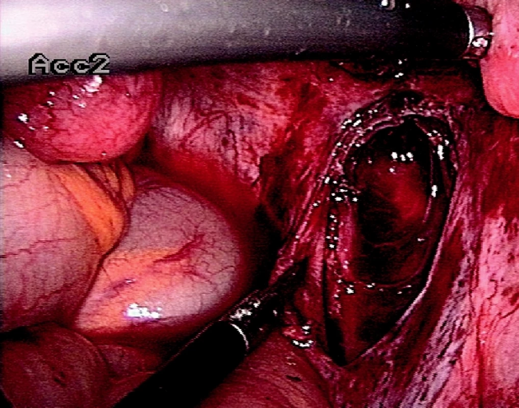 Peritoneální forma endometriózy - stav po excizi ložiska