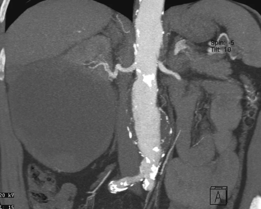 CTA obraz tumoru pravé ledviny a AAA
Fig. 6. CTA view of the right kidney tumor and AAA