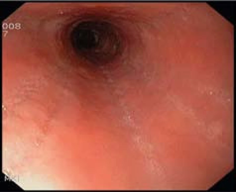 Endoskopický obraz zúženého lumen jícnu s podélnými rýhami u pacienta s dg. EoE.
Fig. 5. Endoscopic image of narrow esophageal lumen with longitudinal furrows in a patient with EoE.