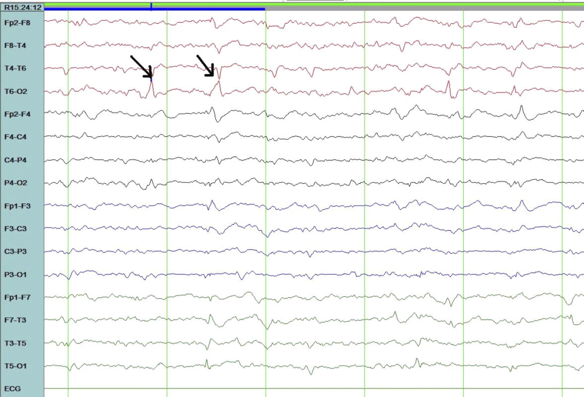 Electroencephalogram Showing Repetitive Focal Spikes or Sharps Less Than Three per Second