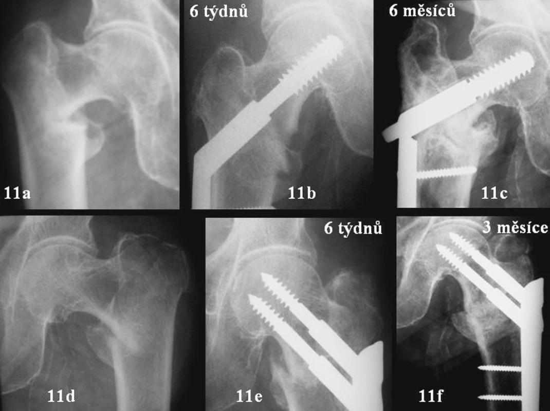 11a-c – zlomenina 31A1.2 vpravo u 76leté pacientky – DHS. Zlomení dlahy, zhojení za 6 měsíců. 11d-f – stejná pacientka, stejná zlomenina po jednom roce vlevo. PCCP – zhojení za 3 měsíce s impakcí do 2 mm ve správném postavení
Fig. 11a-f. 11a-c – Type 31A1.2 fracture on the right in a 76-year old female patient – DHS. Broken plate, healed in 6 months. 11d-f – the same patient, the same fracture on the left in a year-time. PCCP – healed in 3 months with impaction of less than 2 mm, in a correct position