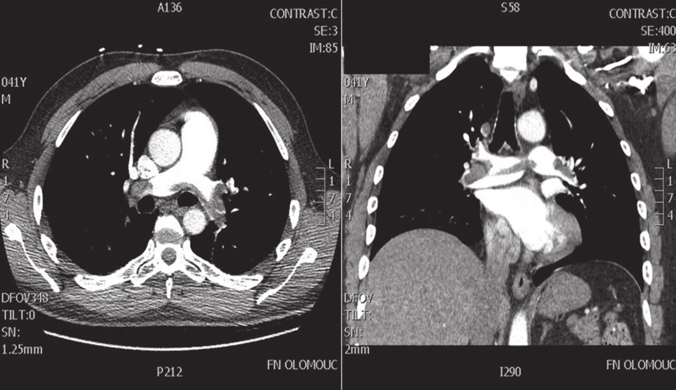 CT angiografie paracentrální formy plicní embolizace
Fig. 2. CT angiography of centrally located pulmonary embolism