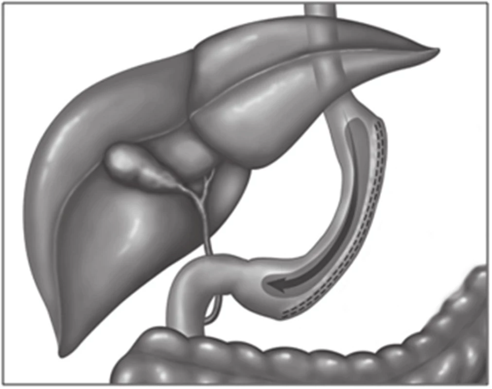 Sleeve gastrectomy − tubulizace žaludku
Fig. 1: Sleeve gastrectomy