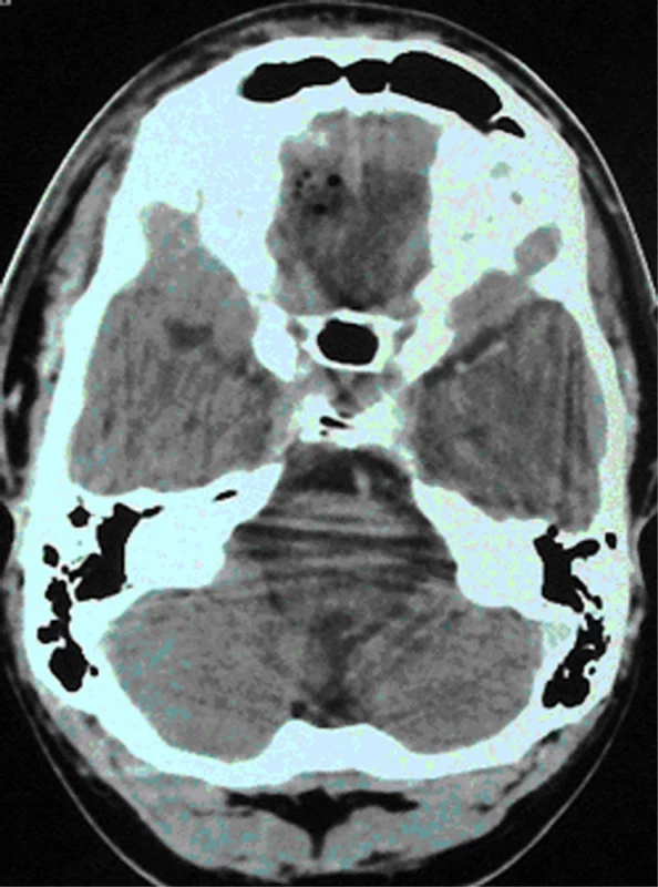 CT časná pooperační kontrola s minimálním pneumocefalem