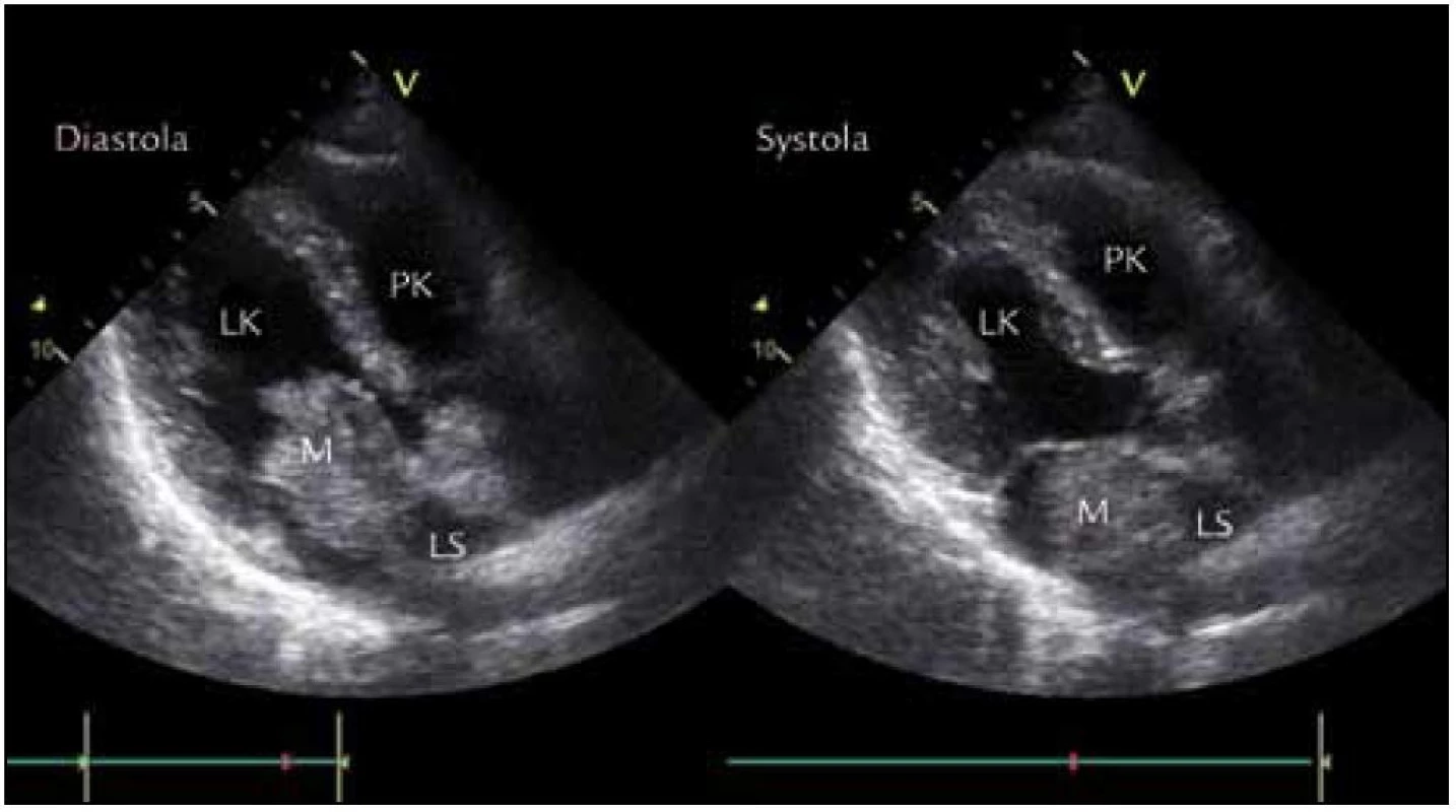 Echokardiografické zobrazení myxomu v PSAX (parasternální projekce na dlouhou osu) v diastole a systole.