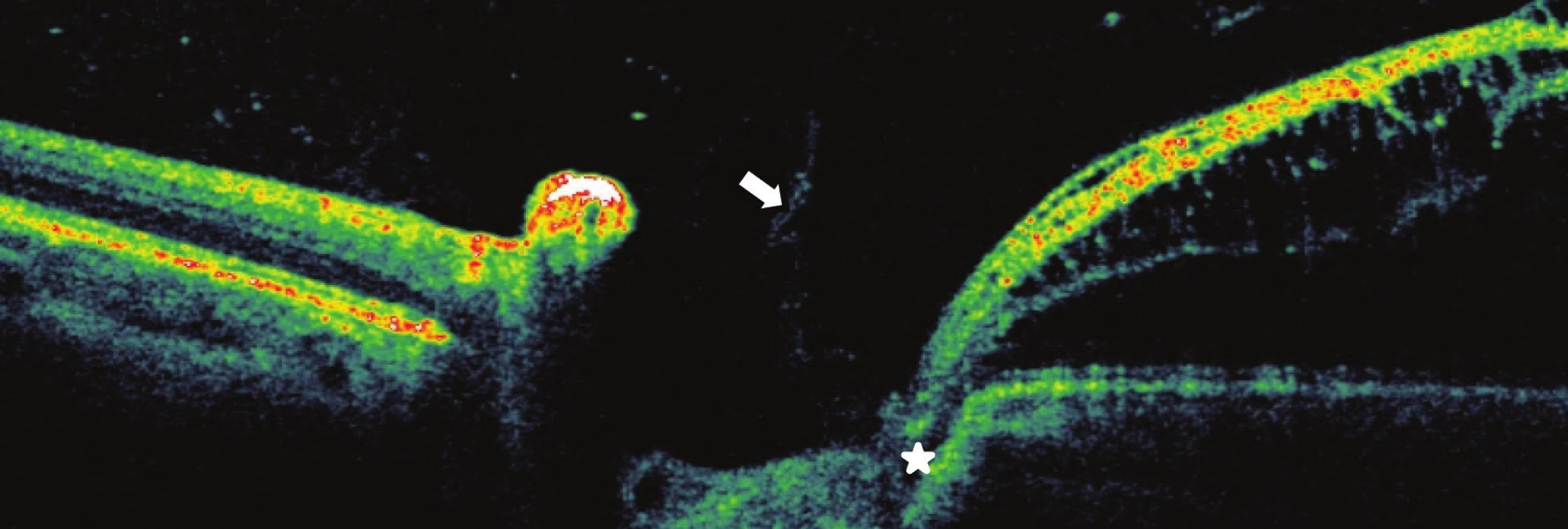 Pacient č. 4
Lineární horizontální transpapilární OCT scan OL, interpapilární proliferace (šipka), zachycena komunikace jamky terče s makulární retinoschízou zevní vrstvy sítnice RSE*