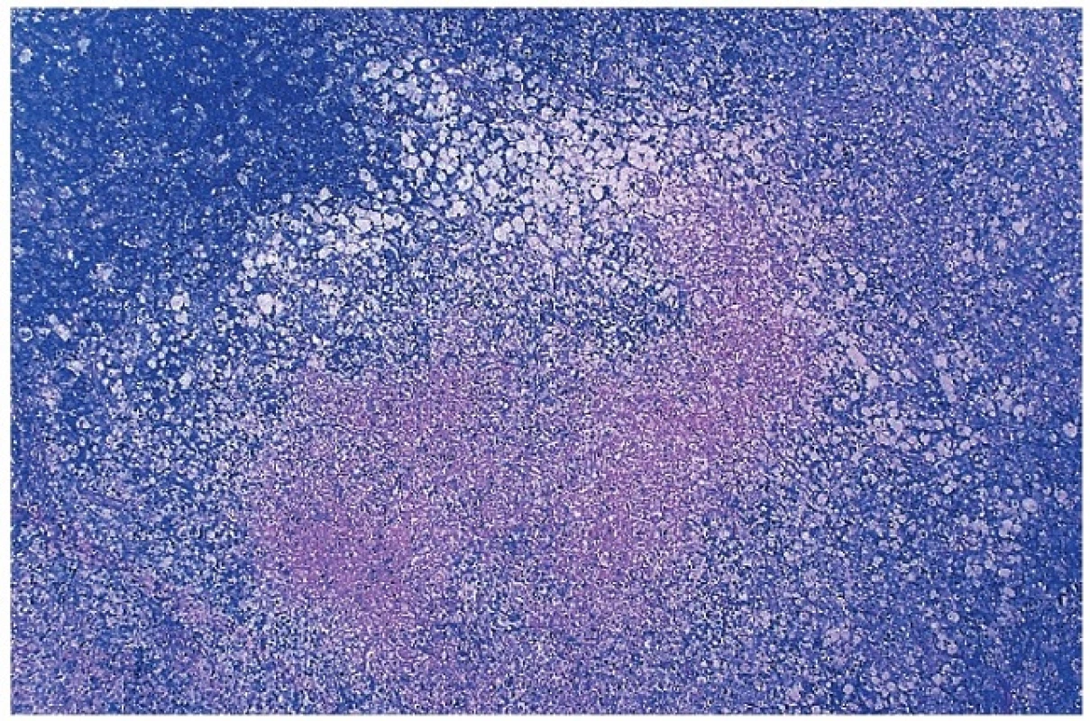 Přehled nekrotického úseku v parakortexu lymfatické uzliny s převahou pěnitých makrofágů v okolí nekrózy, tzv. Xantomatózní typ. Barveno podle Giemsy (zvětšení 20x).