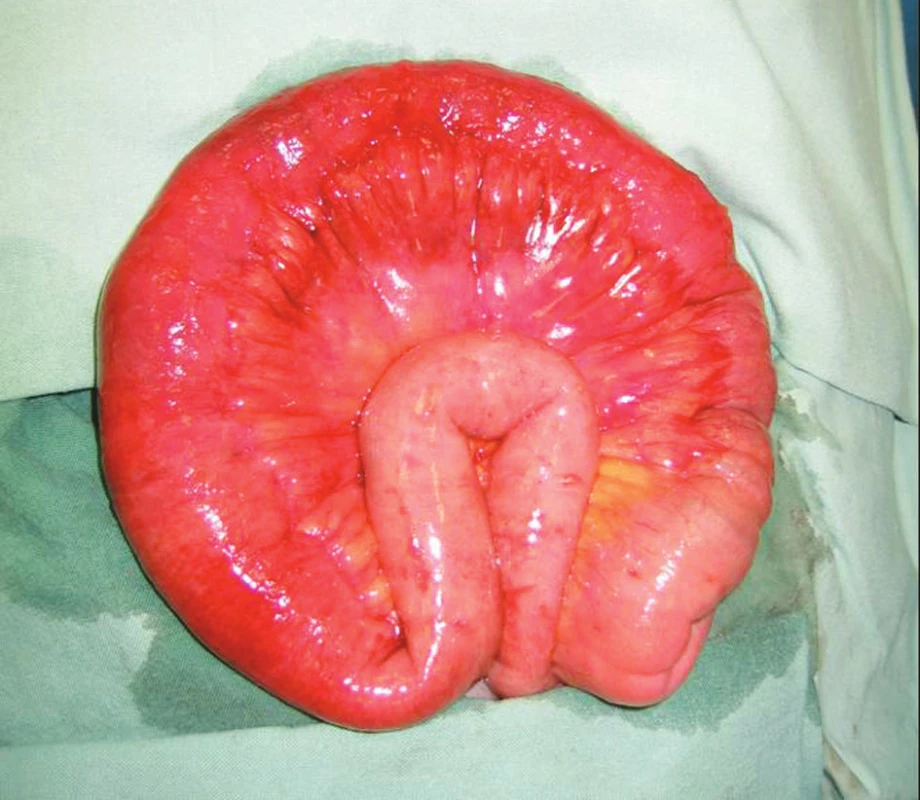 Kazuistika I – Sporně vitální úsek tenkého střeva
Fig. 3. Case report I – The segment of small intestine with uncertain vitality