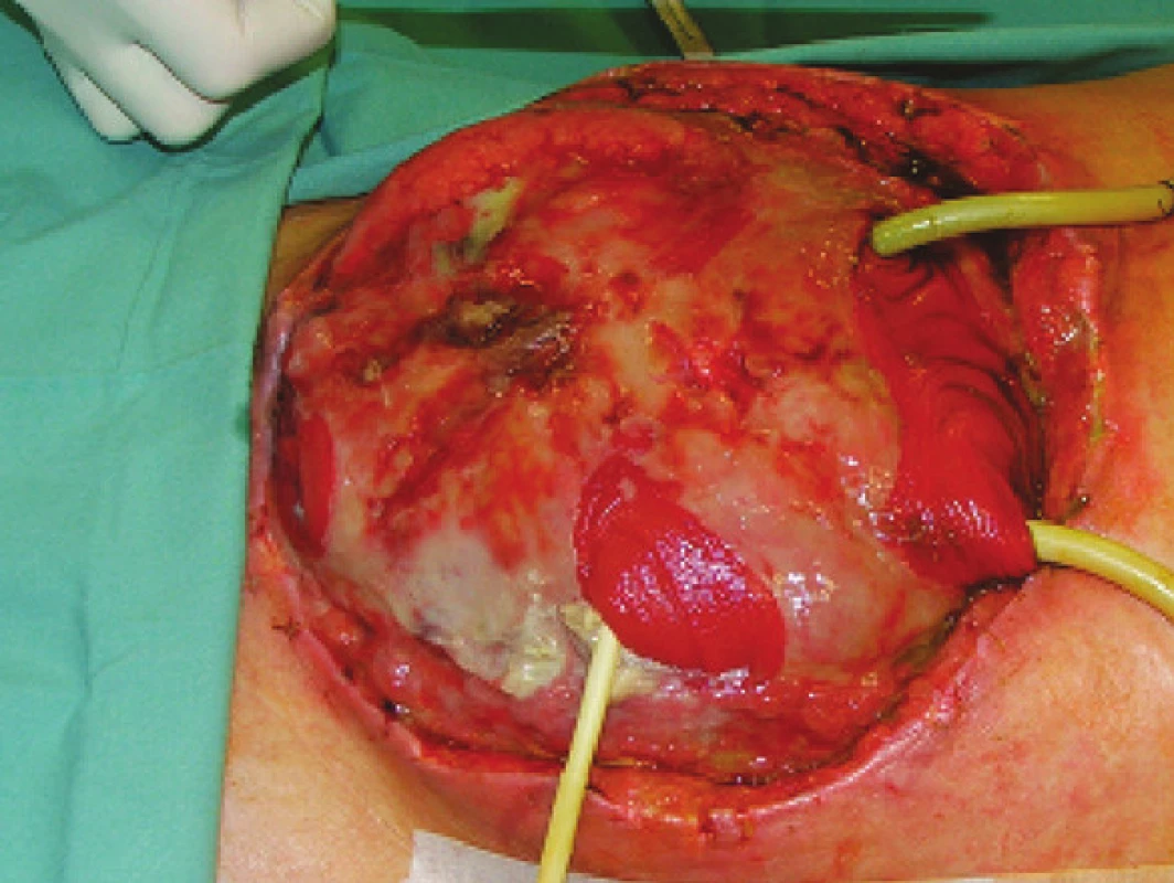 Mnohočetné píštěle z tenkého střeva v rozsáhlém abdominálním defektu (pacient č. 9)
Fig. 1. Multiple small intestinal fistulas in an extensive abdominal defect (patient No 9)