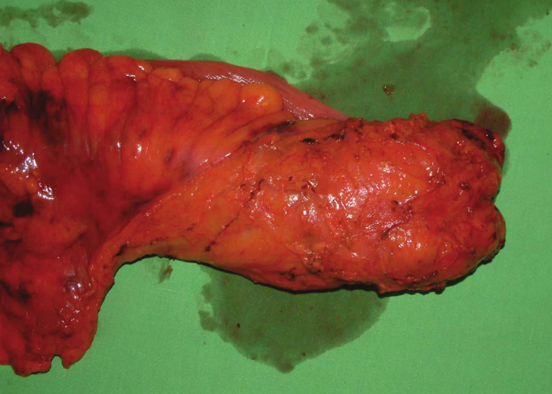 Makroskopický preparát rekta s kvalitnou TME (M.E.R.C.U.R.Y. I°)
Fig. 4: Macroscopic specimen of the rectum with high-quality TME (M.E.R.C.U.R.Y. I°)