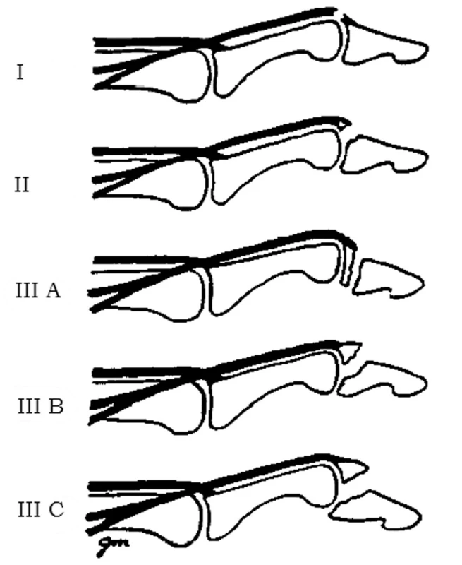 Klasifikácia mallet deformít
I) poranenie extenzorovej šľachy:
– ruptúra alebo oslabenie,
– lacerácia,
II) avulzia extenzorového mechanizmu:
– avulzný fragment menší ako 20 % kĺbového povrchu,
III) mallet zlomeniny:
A) transepifyzeálna zlomenina u detí,
B) hyperflekčná mallet zlomenina – avulzný fragment veľkosti
20 %–50 % kĺbového povrchu bez subluxácie distálneho
článku,
C) hyperextenčná mallet zlomenina – avulzný fragment väčší
ako 50 % kĺbového povrchu s volárnou subluxáciou distálneho
článku [1].
Fig. 1: Mallet finger classification
I) Extensor tendon injury: – rupture or attenuation, – laceration,
II) extensor mechanism avulsion: – fraction fragment less then 20 % of articular surface, III) mallet fractures:
A) transepiphyseal fractures of children,
B) hyperflexion mallet fracture – 20%–50% articular surface fracture without subluxation of DIP joint,
C) hyperextension mallet fracture – more than 50% articular surface fracture with volar subluxation of DIP joint [1].