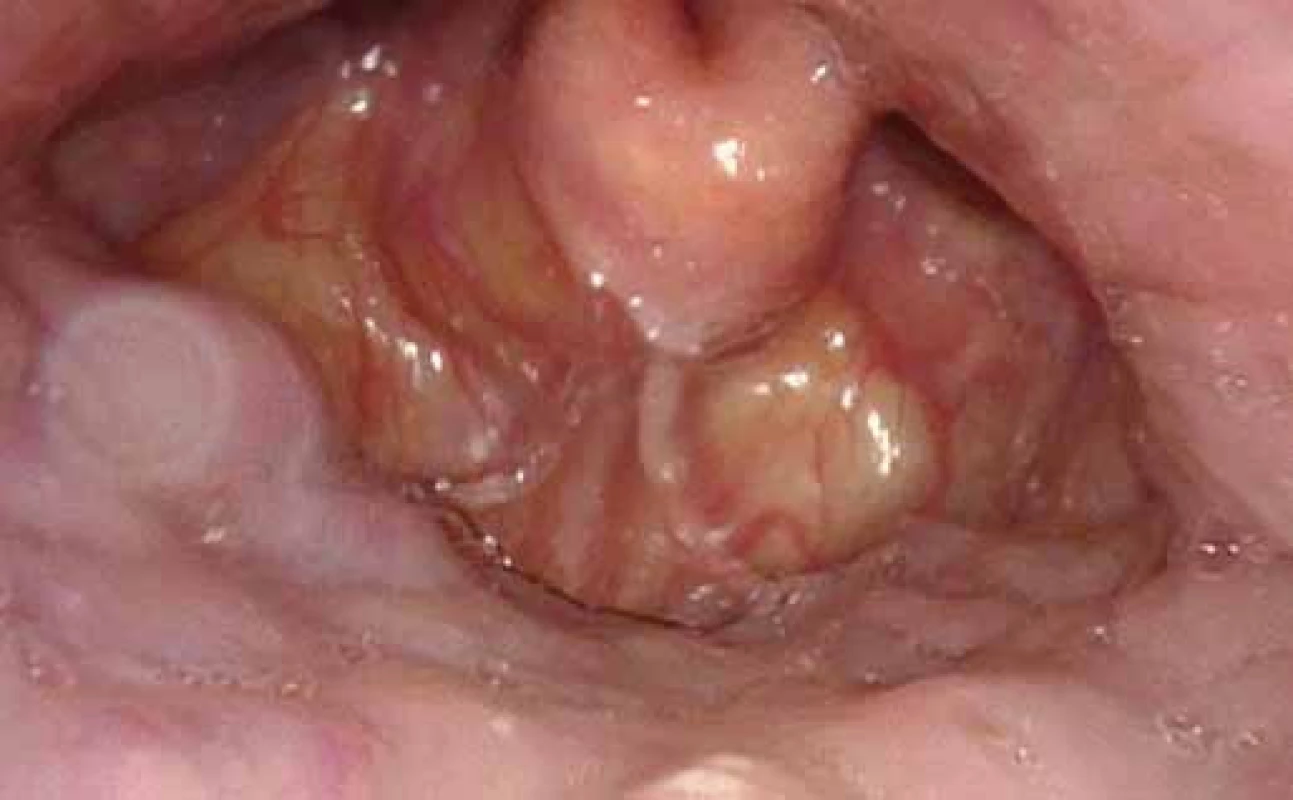 DISE – obstrukce způsobená laterálním kolapsem ztluštělé epiglotis.
Fig. 4. DISE – obstruction caused by lateral collapse of thickened epiglottis.