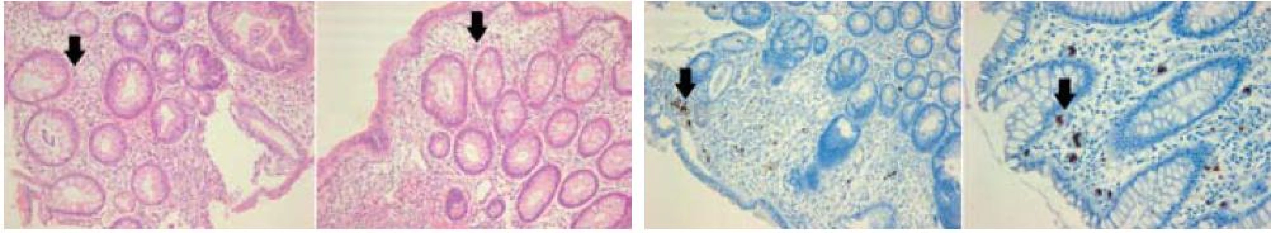 Histologický obraz CMV kolitidy: vlevo – v barvení hematoxylin-eosinem, vpravo – imunohistochemický průkaz CMV (immediate early antigen CMV). Šipky označují typické „megalocyty“ s inkluzemi.
Fig. 1. Histological depiction of CMV colitis: left – coloured haematoxylin-eosin, right – immunohistochemical CMV mark (immediate early antigen CMV). Arrows indicate typical ‘megalocytes’ with inclusions.