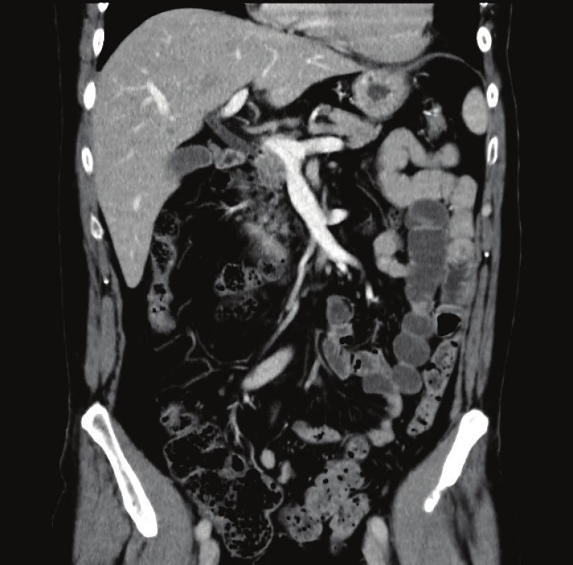 CT obraz vnitřní kýly
Fig. 6: CT scan of internal hernia