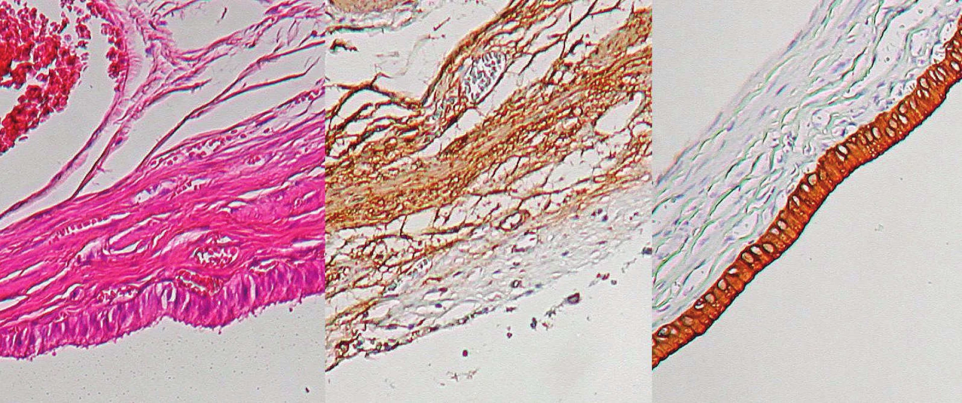 Histologický nález – žlčník, zľava normálne farbenie, v strede svalovina znázornená protilátkami proti aktínu,
vpravo epitel žlčových ciest znázornený protilátkami proti cytokeratínu C19
Fig. 7. Histological preparation – gall-bladder: normal staining on the left, muscle layer stained with monoclonal antibodies
against actin in the middle, biliary epithelium stained with antibodies against cytokeratin C19 on the right